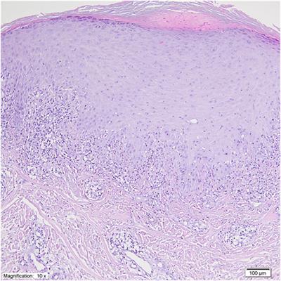 Case report: Lichenoid eruption under immunotherapy with MK-4830 and pembrolizumab in a breast cancer patient